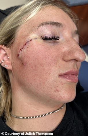 Juliah Thompson, 21, Ignores Mole That Transforms Over Three Months Despite Vigilant Skin Care