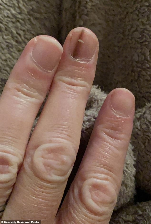 A Faint Brown Line Under the Nail: A Warning Sign of Rare, Deadly Cancer That Led to Amputation