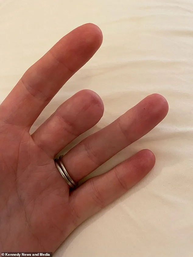 A Faint Brown Line Under the Nail: A Warning Sign of Rare, Deadly Cancer That Led to Amputation