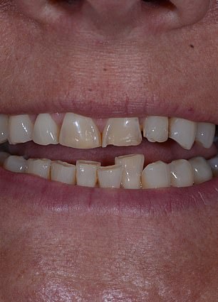 Confidence Reclaimed: Mandy Turver's Journey to a Brighter Smile After Overcoming Dental Anxiety