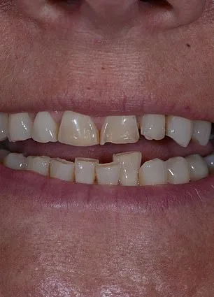 Confidence Reclaimed: Mandy Turver's Journey to a Brighter Smile After Overcoming Dental Anxiety