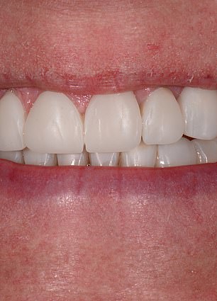 Confidence Reclaimed: Mandy Turver's Journey to a Brighter Smile After Overcoming Dental Anxiety