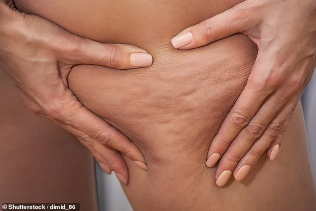 Lipoedema: The Hidden Condition Behind Celebrities' Stubborn Fat