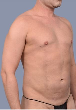 Frank Hoyle Spends $23,000 on Liposuction to Remove Stubborn Abdominal Pouch
