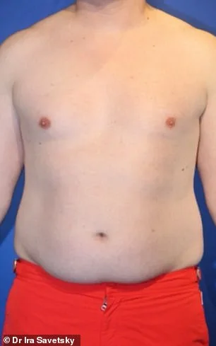 Frank Hoyle Spends $23,000 on Liposuction to Remove Stubborn Abdominal Pouch