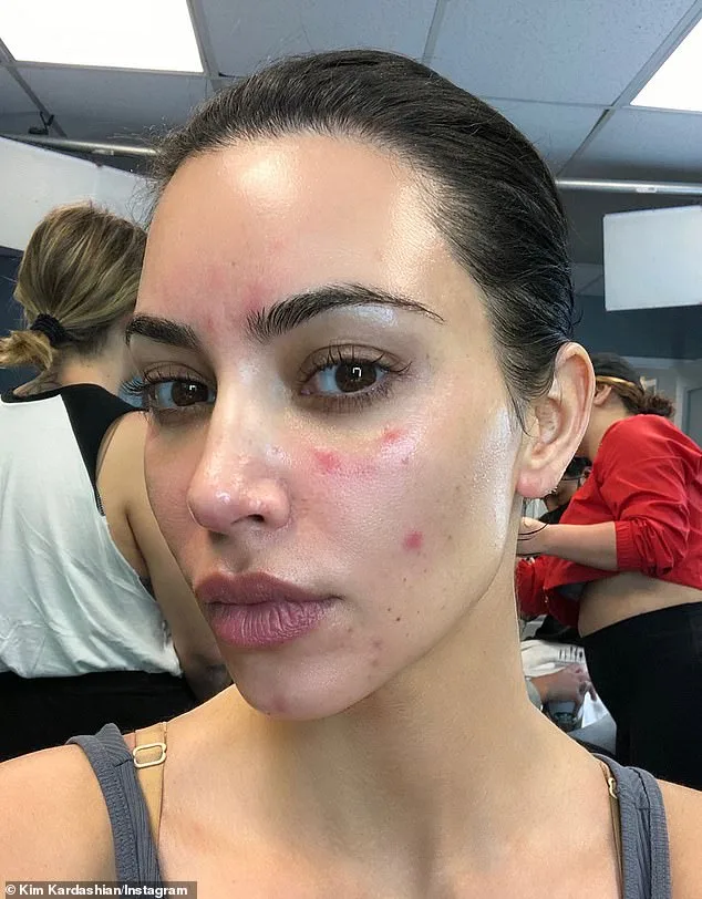 UK Psoriasis Crisis: Addressing Stigma, Misconceptions, and Mental Health Challenges