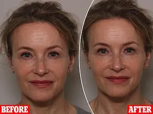 UK Psoriasis Crisis: Addressing Stigma, Misconceptions, and Mental Health Challenges