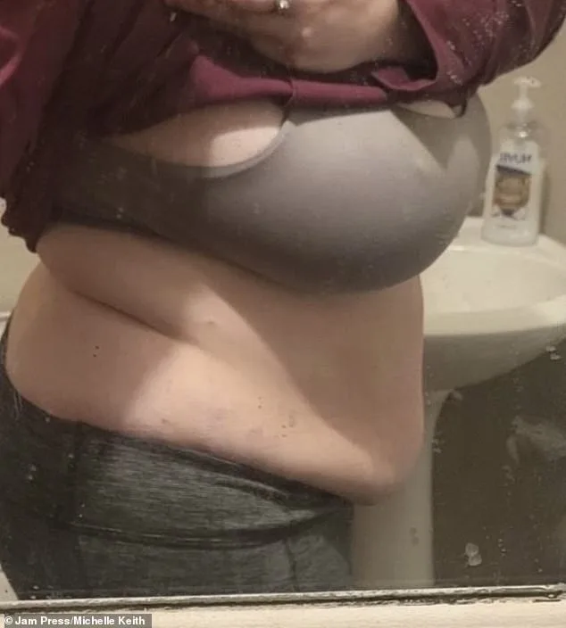 From Mirror to Misdiagnosis: How Lipoedema Changed Michelle Keith's Life