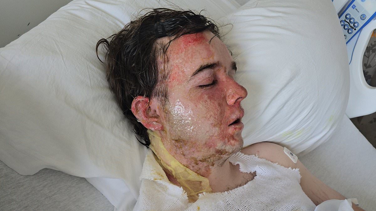 McDonald's Manager Suffers Severe Burns After Coworker Throws Hot Oil