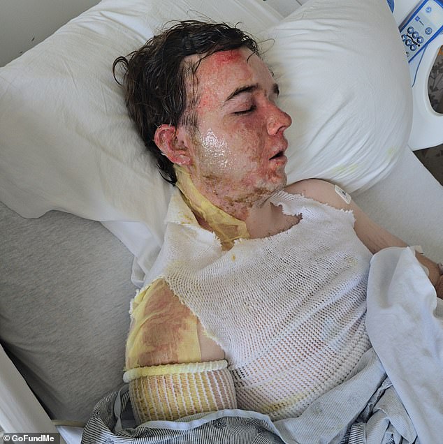 McDonald's Manager Suffers Severe Burns After Coworker Throws Hot Oil
