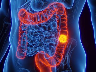 High Birth Weight Linked to Surge in Bowel Cancer for Young Adults