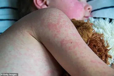 Frontline Doctors Sound Alarm as Measles Outbreak Devastates Texas Town