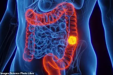 Low-Carb Diets Linked to Increased Risk of Colon Cancer: New Study Reveals Concerning Health Risks