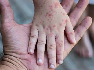 Measles Outbreak in the US: A Public Health Concern