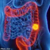 New Blood Test Detects Early Signs of Bowel Cancer, Boosting Survival Chances