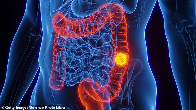 New Blood Test Detects Early Signs of Bowel Cancer, Boosting Survival Chances