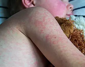 Ontario Teacher's Measles Battle Reveals Limits of Vaccination and Importance of Herd Immunity