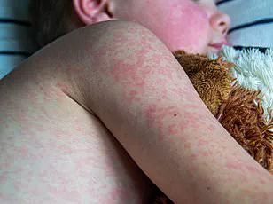 Ontario Teacher's Measles Battle Reveals Limits of Vaccination and Importance of Herd Immunity