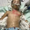 Seven-Year-Old Girl Injured After Following Online Trend of Microwaving Toys