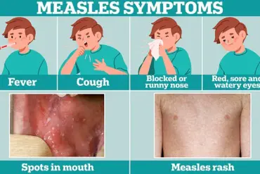 Washington D.C. Health Officials Issue Alert After Measles Case at Multiple Public Locations