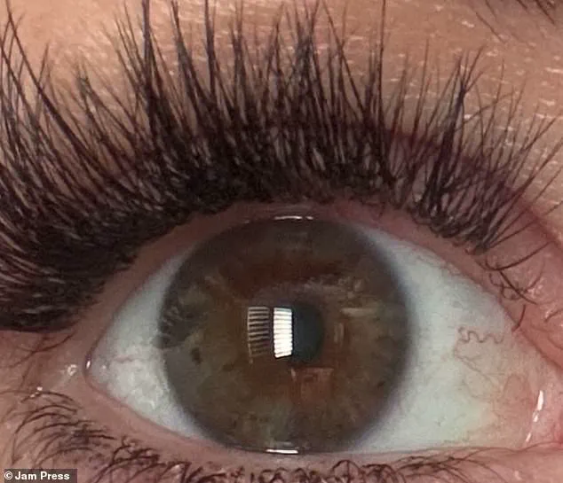 Woman Struck by Lightning Survives with Changed Eye Color