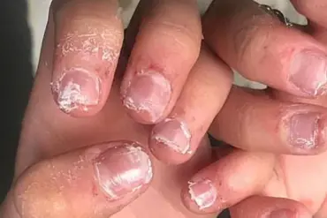 Audiologist Warns: Long Fake Nails Can Cause Severe Ear Infections and Tinnitus