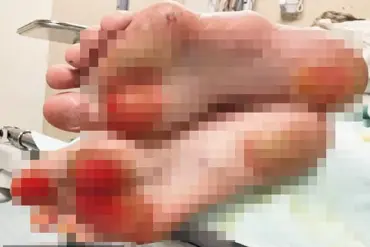 Doctors Warn of Severe Burns from Walking Barefoot on Hot Asphalt During Heat Waves