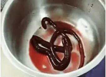 Man Admitted to Hospital with Three-Foot-Long Worm Removed from Bladder
