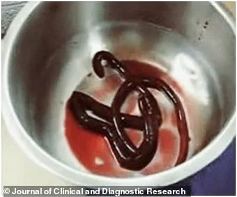 Man Admitted to Hospital with Three-Foot-Long Worm Removed from Bladder