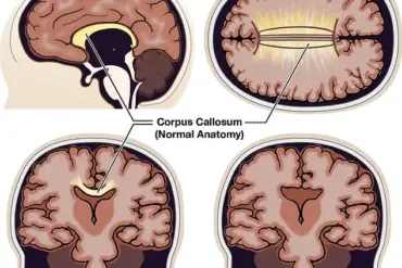 Real-Life Split Brain: Living With Agenesis of the Corpus Callosum