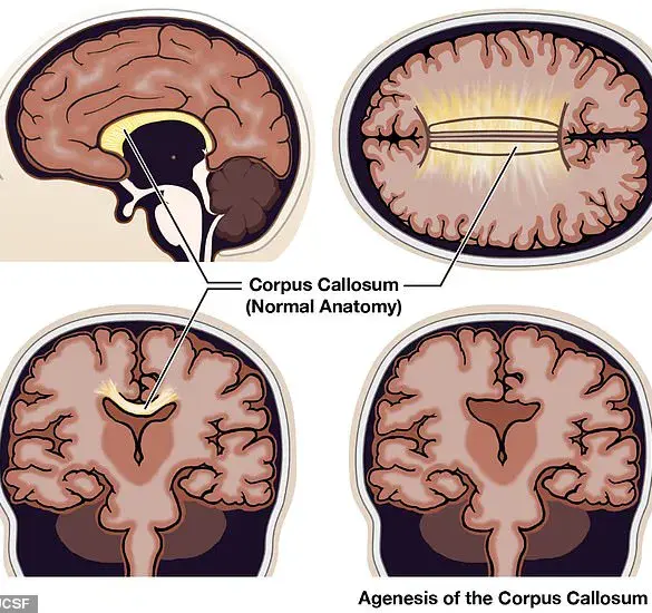 Real-Life Split Brain: Living With Agenesis of the Corpus Callosum