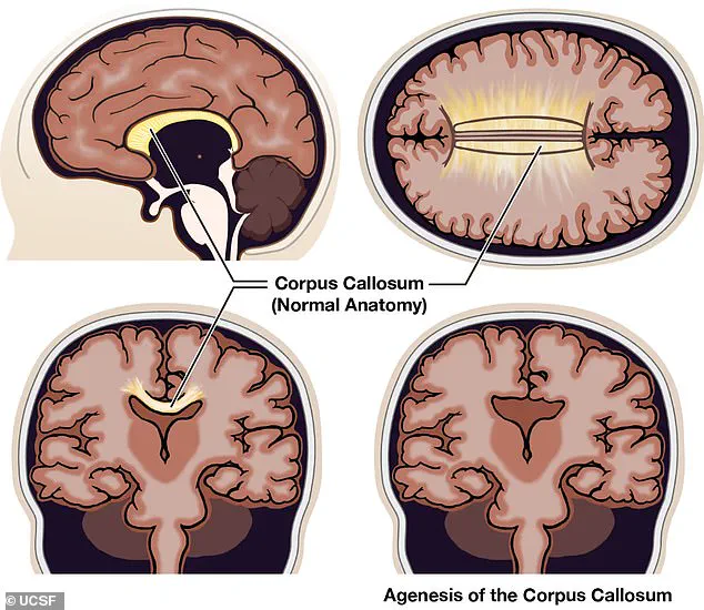 Real-Life Split Brain: Living With Agenesis of the Corpus Callosum