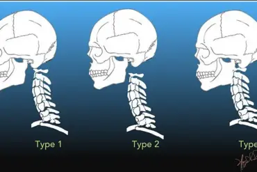 Surviving the Rare Horror: One Man's Battle Against Internal Decapitation