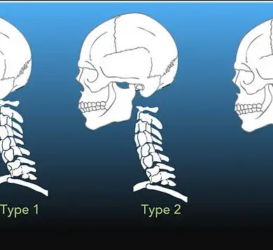 Surviving the Rare Horror: One Man's Battle Against Internal Decapitation