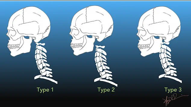 Surviving the Rare Horror: One Man's Battle Against Internal Decapitation