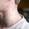 Texas Health Officials Warn of Measles Case at Major Baseball Event