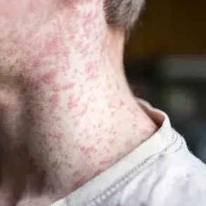 Texas Health Officials Warn of Measles Case at Major Baseball Event