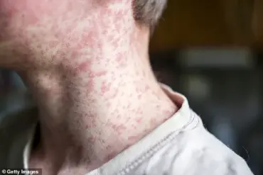 Texas Health Officials Warn of Measles Case at Major Baseball Event