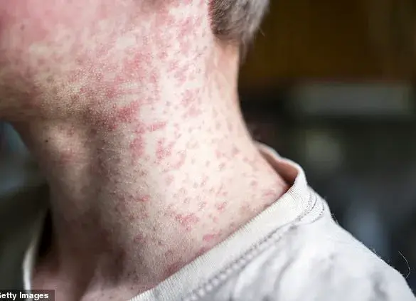 Texas Health Officials Warn of Measles Case at Major Baseball Event