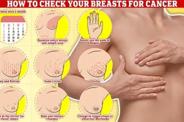 Urgent Policy Shift: NHS Expands Breast Cancer Screening to Women in Their 30s as Data Reveals Over 10,000 Annual Diagnoses Under 50
