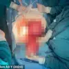 Urgent: Tunisian Pregnant Woman's Hydatid Cyst Removal Sparks Global Medical Warnings