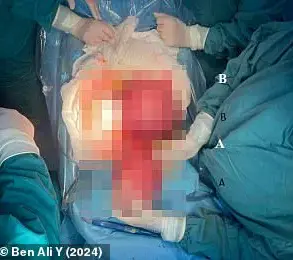 Urgent: Tunisian Pregnant Woman's Hydatid Cyst Removal Sparks Global Medical Warnings