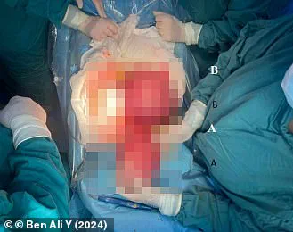 Urgent: Tunisian Pregnant Woman's Hydatid Cyst Removal Sparks Global Medical Warnings