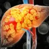 Rising Global Burden of Liver Cancer: Projections Show Cases Could Double by 2050, with Growing Impact on Younger Adults, According to The Lancet Analysis