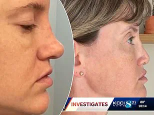 Miami Woman Files Lawsuit Over Botched Breast Augmentation, Alleging Negligence in Treating Tissue Necrosis