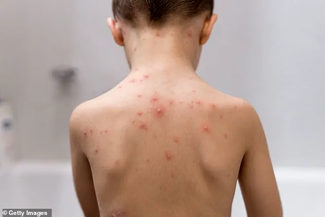 NHS to Vaccinate All Babies Against Chickenpox in Major Public Health Expansion