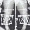 The Controversy of Limb Lengthening Surgery: Medical Innovation and the Human Cost